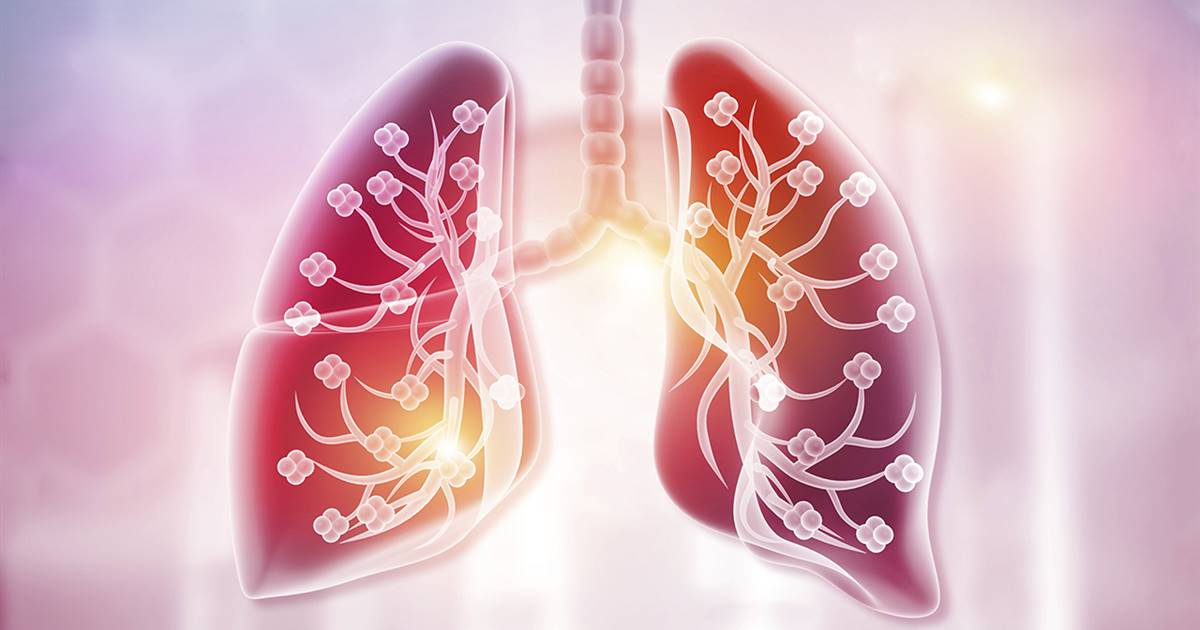 Bronquitis: qué es, síntomas y tratamiento