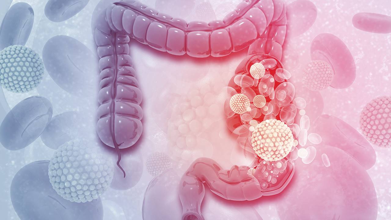 cancer de colon y estrenimiento