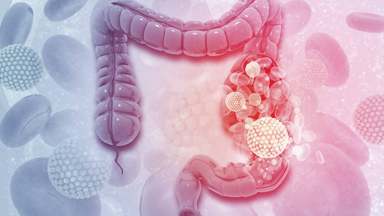 Cáncer de colon y recto síntomas y tratamiento