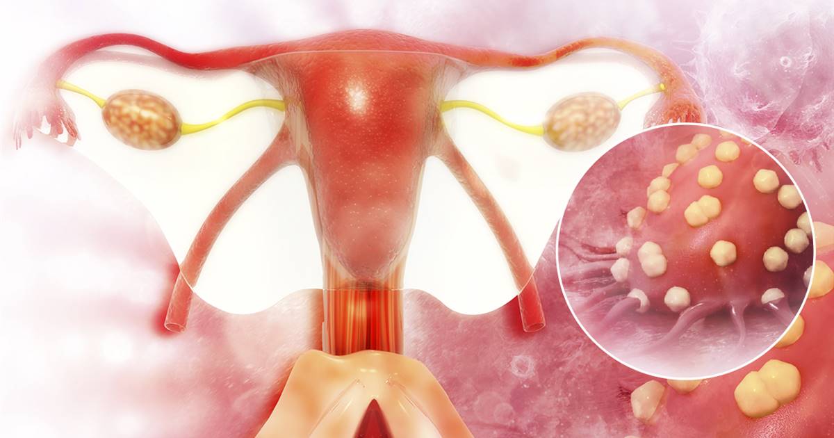 Cancer epitelial de ovario slideshare - soaptele.ro Cancer epitelial de ovario tratamiento