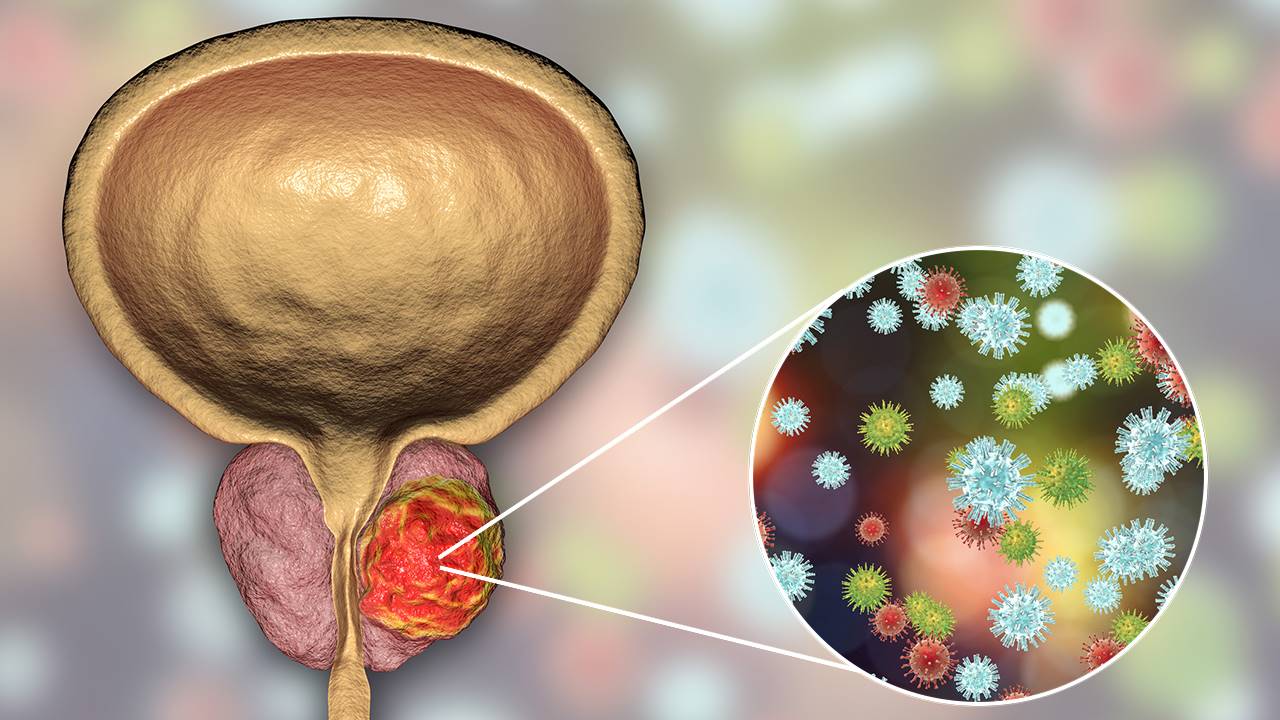 Cancerul de prostată | Oncologie SANADOR