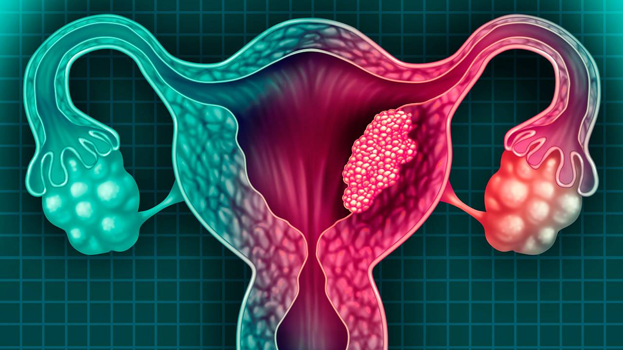 Síntomas después de quitar un pólipo uterino