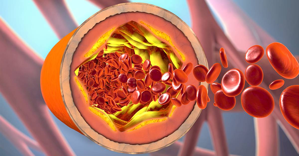 Colesterol alto: qué es, síntomas y cómo bajar sus niveles
