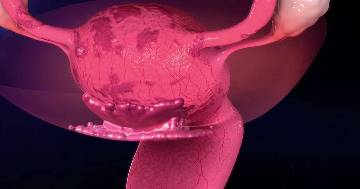 Endometrioma tratamiento