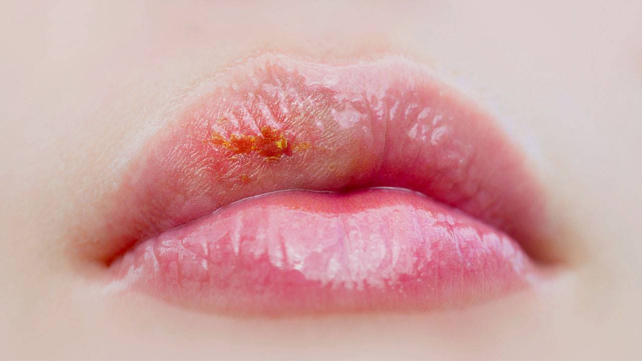 Herpes Labial Sintomas Y Tratamiento