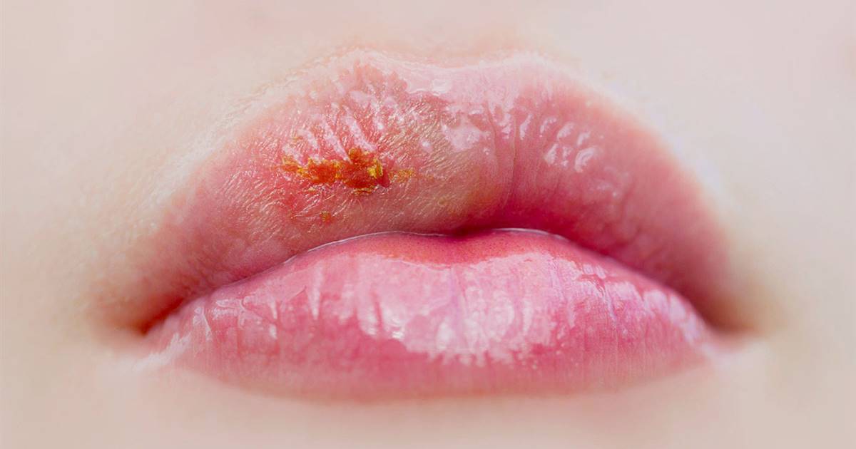 Consejos de salud: herpes labial