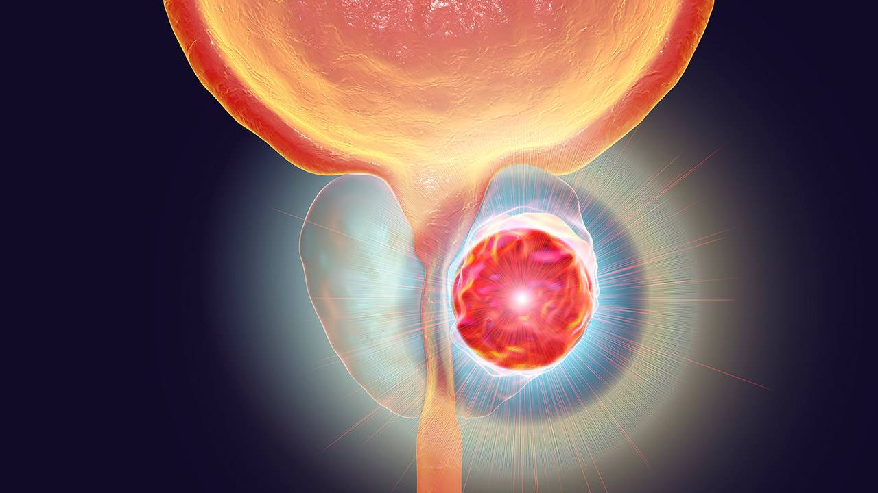 kefir prostatitis